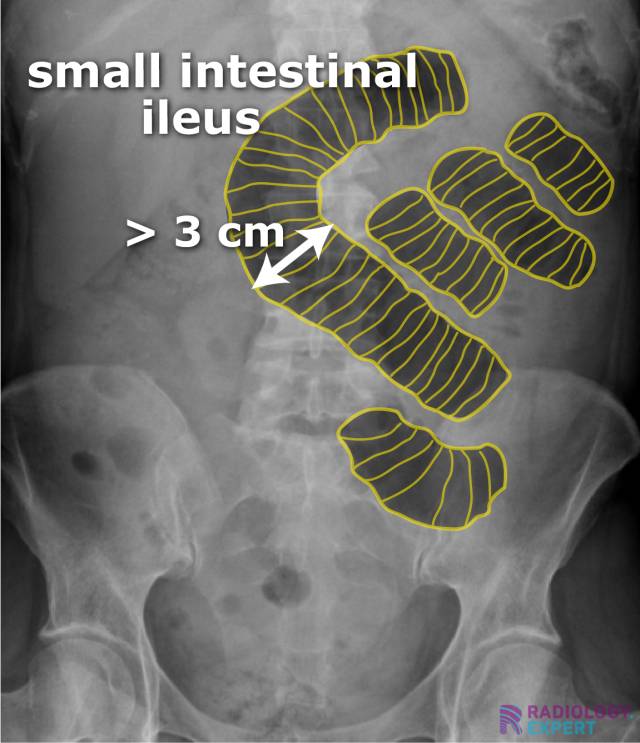 Abdominal x ray